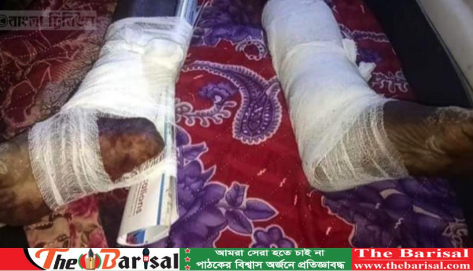 এবার পটুয়াখালী‌তে নারকীয় নির্যাতন / শেফালী বেগমের পায়ের হাড় গুঁড়িয়ে দিয়েছে সন্ত্রাসীরা