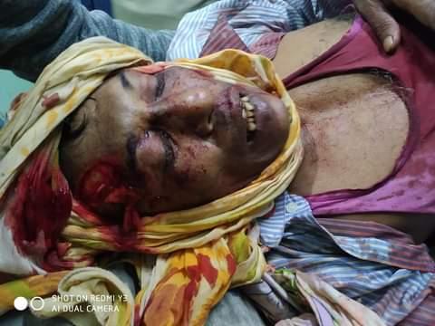 হিজলায় করে বড় ভাইয়ের পা কর্তন ॥ ভাবিকে কুপিয়ে জখম